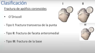 Luxación de hombro (Tracciones) Técnica de spaso
I. Paciente en decúbito supino.
II. La extremidad afectada se toma
por la muñeca o antebrazo
distal y se tira en dirección
vertical, aplicando una sutil
tracción. El hombro se rota
externamente y la reducción
ocurre espontáneamente.
 