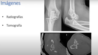 Luxación de hombro (Tracciones) Método de Milch
I. Paciente en decúbito supino.
II. Abducir y rotar externamente
el brazo hacia arriba de la
cabeza.
III. Aplicar tracción sobre el
brazo extendido.
 