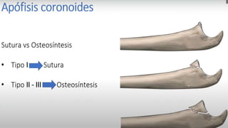 Tratamiento de la luxación del codo
Reducción bajo sedaciónoanestesiageneral :
Tracción del antebrazo
en flexión de codo
contra tracción del brazo
± presiónsobre el olécranon
Yeso braquipalmar en f lexióndurante 3 semanas
 