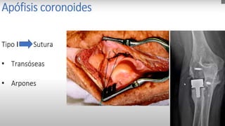 Reduction of a posterior elbow dislocation consists of longitudinal traction (A),
correction of lateral or medial displacement (B), and flexion of the elbow (C).
 