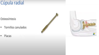 FRACTURA RADIO CUBITAL DISTAL
CLASIFICACION ABIERTA O CERRADA CON
DESPLAZAMIENTO , ANGULACION ,
CONMINUCION Y ACORTAMIENTO DEL RADIO
 