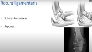 Clasificación de Frykman
fractura ausente presente
Extraarticular I II
Intraarticular que afecta Articulación radiocarpiana III IV
Intraarticular que afecta Articulación Radiocubital
distal
V VI
Intraarticular que afecta ambas articulaciones VII VIII
 