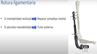 Clasificación de Fernández
Clasificación de Fernández
Tipo I Fx metafisaria por flexión con perdida
de la inclinación palmar y
acortamiento relativo del radio con
respecto al cubito
Tipo II Fx por cizallamiento q necesita
reducción y a menudo apuntalar el
segmento articular
Tipo III Fx por compresión de la superficie
articular sin la fragmentación
característica; lesiones ligamentosas
graves
Tipo IV Fx por avulsión o fractura-luxación
radiocarpiana
Tipo V Lesión combinada con importante
afectación de partes blandas
 