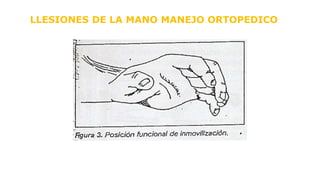 LLESIONES DE LA MANO MANEJO ORTOPEDICO
 