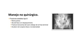 Manejo no quirúrgico.
 Fracturas estables tipoA
 Rama pubica
 Ala del iliaco sin desplazamiento
 Fractura transversa del sacro debajo de la línea terminal
 Avulsion de la espina iliaca o la tuberosidad isquiática
 