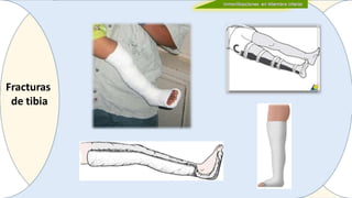 Fracturas
de tibia
 