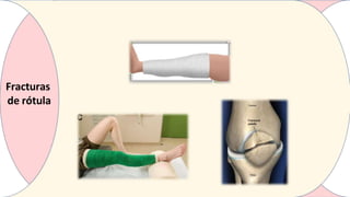 Fracturas
de rótula
 