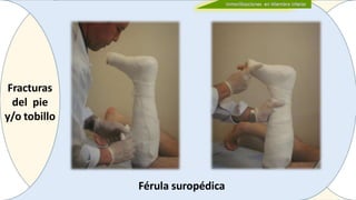 Fracturas
del pie
y/o tobillo
Férula suropédica
 