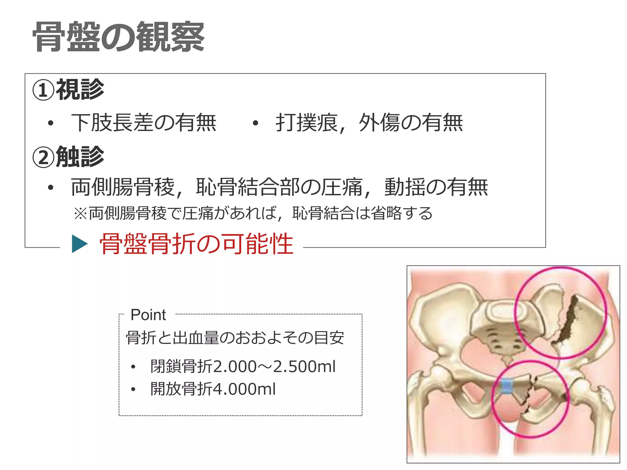 骨盤の観察
• 下肢長差の有無
• 両側腸骨稜，恥骨結合部の圧痛，動揺の有無
※両側腸骨稜で圧痛があれば，恥骨結合は省略する
• 打撲痕，外傷の有無
▶ 骨盤骨折の可能性
Point
骨折と出血量のおおよその目安
• 閉鎖骨折2.000〜2.500ml
• 開放骨折4.000ml
①視診
②触診
 