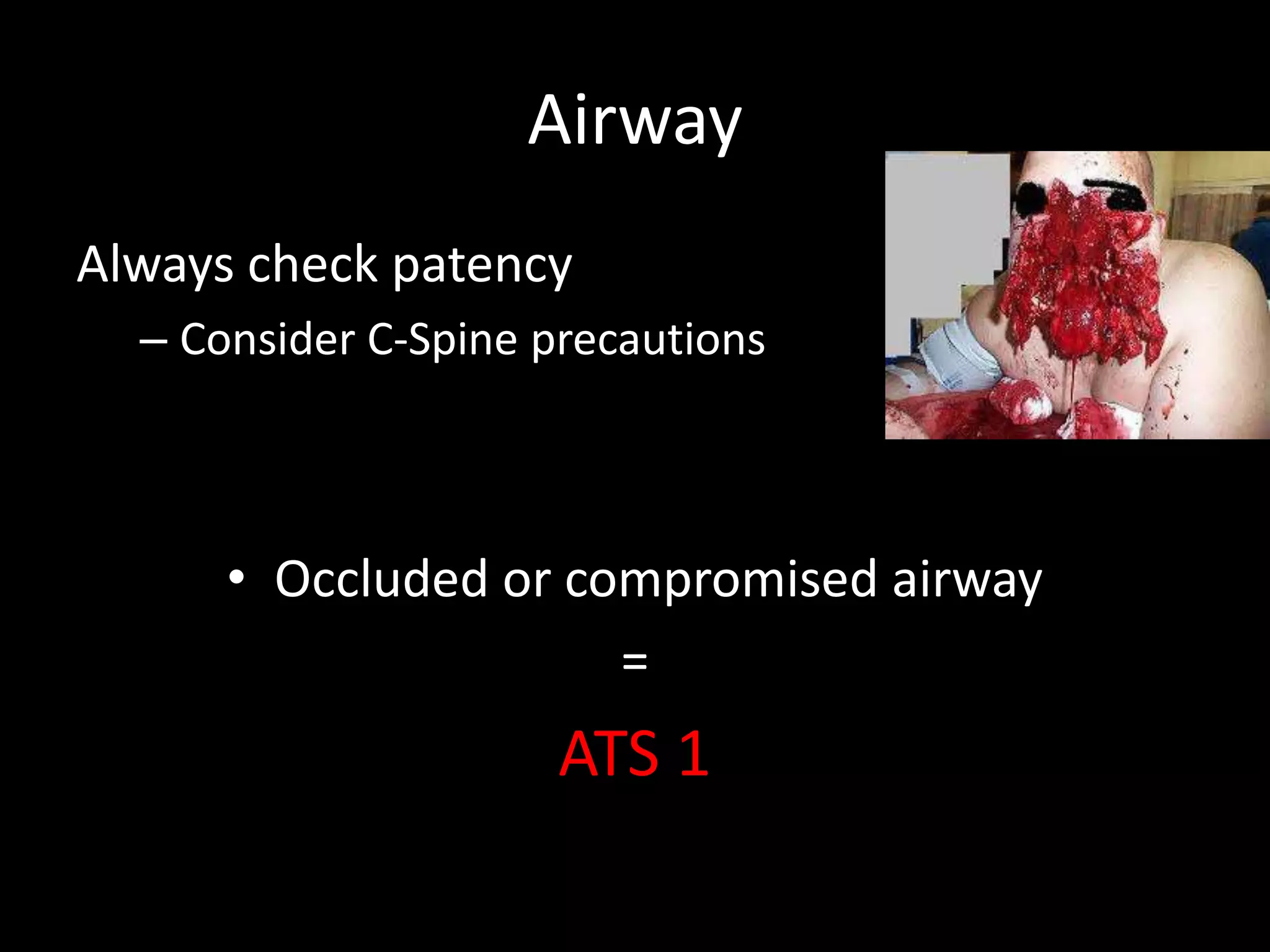 Airway
Always check patency
– Consider C-Spine precautions
• Occluded or compromised airway
=
ATS 1
 