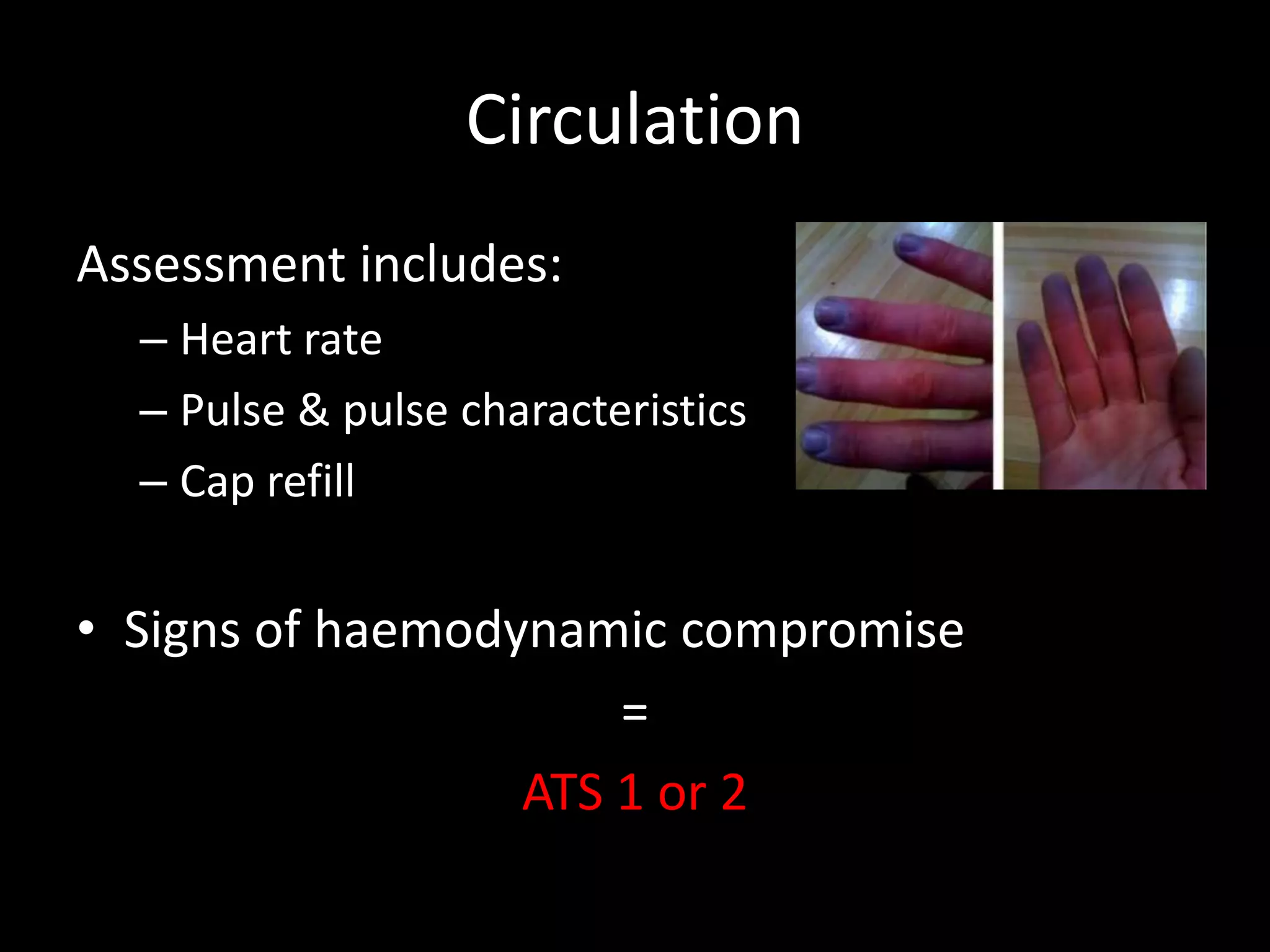 Circulation
Assessment includes:
– Heart rate
– Pulse & pulse characteristics
– Cap refill
• Signs of haemodynamic compromise
=
ATS 1 or 2
 