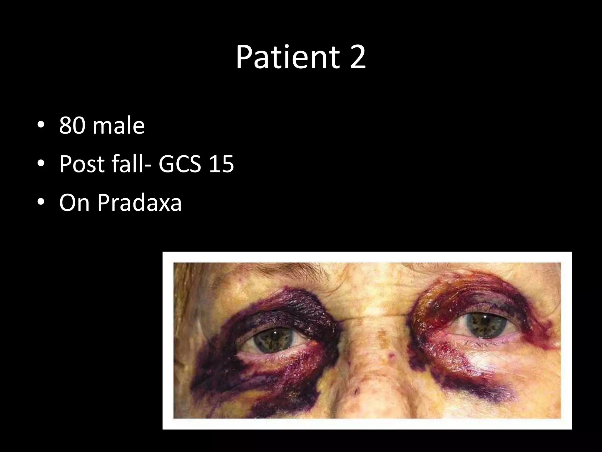 Patient 2
• 80 male
• Post fall- GCS 15
• On Pradaxa
 