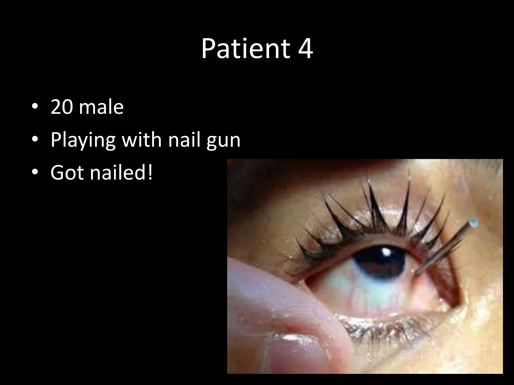 Patient 4
• 20 male
• Playing with nail gun
• Got nailed!
 