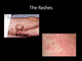 The Rashes
 