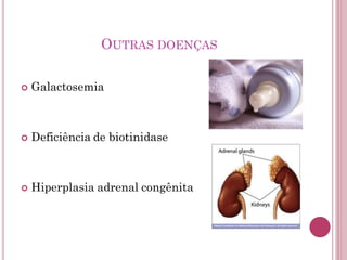 OUTRAS DOENÇAS
 Galactosemia
 Deficiência de biotinidase
 Hiperplasia adrenal congênita
 