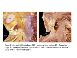 Asterisk (∗) = central fibrous body, CSO = coronary sinus ostium, ER = Eustachian
ridge, ICV = inferior cava vein, OF = oval fossa, STV = septal leaflet of the tricuspid
valve, and TT = tendon of Todaro.
 