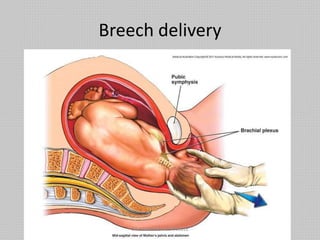 Breech delivery
DR NDAYISABA CORNEILLE
 