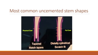 Most common uncemented stem shapes
 