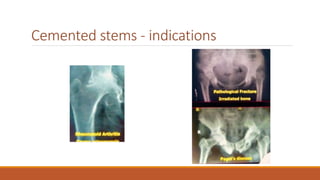 Cemented stems - indications
 