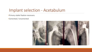 Implant selection - Acetabulum
•Primary stable fixation necessary
•Cemented / Uncemented
 