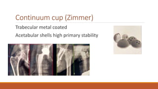 Continuum cup (Zimmer)
Trabecular metal coated
Acetabular shells high primary stability
 