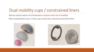 Dual mobility cups / constrained liners
•May be used to reduce risk of dislocation in patients with risk of instability
•Rate of polyethylene wear in these cups not yet clear, should be examined further.
 