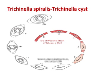 Trichinella spiralis-Trichinella cyst
 