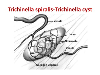 Trichinella spiralis-Trichinella cyst
 