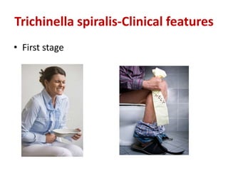Trichinella spiralis-Clinical features
• First stage
 