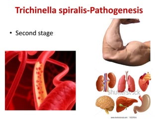 Trichinella spiralis-Pathogenesis
• Second stage
 