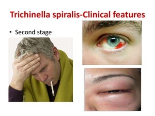 Trichinella spiralis-Clinical features
• Second stage
 