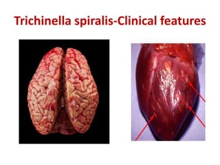 Trichinella spiralis-Clinical features
 