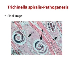 Trichinella spiralis-Pathogenesis
• Final stage
 
