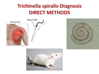 Trichinella spiralis-Diagnosis
DIRECT METHODS
 