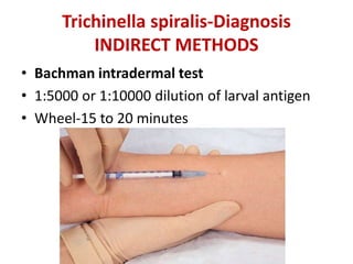 Trichinella spiralis-Diagnosis
INDIRECT METHODS
• Bachman intradermal test
• 1:5000 or 1:10000 dilution of larval antigen
• Wheel-15 to 20 minutes
 