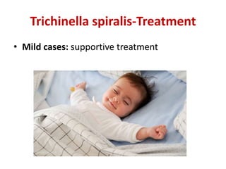 Trichinella spiralis-Treatment
• Mild cases: supportive treatment
 