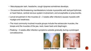  Maculopapular rash, headache, cough dyspnea sometimes develops.
 Occasional life-threatening manifestations include myocarditis with tachyarrhythmias
or heart failure, central nervous system involvement, and encephalitis or pneumonitis.
 Larval encystment in the muscles (2 – 3 weeks after infection) causes myositis with
myalgia and weakness.
 The most commonly involved muscle groups include the extraocular muscles, the
biceps and the muscles of the jaw, neck, lower back and diaphragm.
 Peaking ~ 3 weeks after infection symptoms subside gradually during a prolonged
convalescence.
Splinter hemorrhages Swollen eyes
 