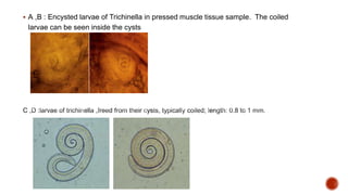  A ,B : Encysted larvae of Trichinella in pressed muscle tissue sample. The coiled
larvae can be seen inside the cysts
 