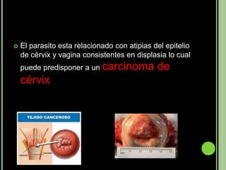    El parasito esta relacionado con atipias del epitelio
    de cérvix y vagina consistentes en displasia lo cual
    puede predisponer a un carcinoma          de
    cérvix
 