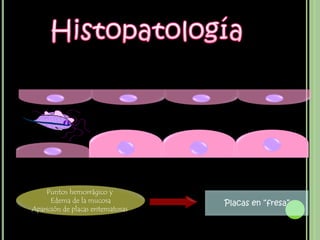 Puntos hemorrágico y
      Edema de la mucosa           Placas en “fresa”
Aparición de placas eritematosas
 