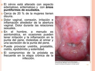  El cérvix está alterado con aspecto
edematoso, eritematoso y con áreas
puntiformes de exudados.
 Cerca de 20 % de la mujeres tienen
disuria.
 Dolor vaginal, comezón, irritación e
inflamación alrededor de la abertura
vaginal. Dolor durante las relaciones
sexuales.
 En el hombre, a menudo es
asintomática, en ocasiones pueden
tener irritación y la inflamación en la
punta del pene, molestias al orinar y
una secreción de la punta del pene.
 Puede provocar uretritis, prostatitis,
cistitis, epididimitis y esterilidad.
 El compromiso de la próstata es
frecuente en la etapa crónica de la
infección.
 