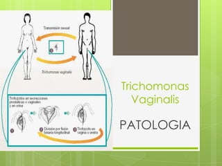 Trichomonas
Vaginalis
PATOLOGIA
 