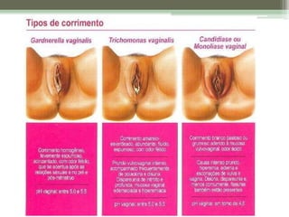 Trichomonas vaginalis entenda mais sobre ela
