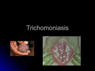 Trichomoniasis
 