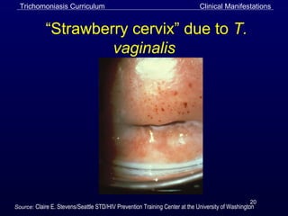 20
“Strawberry cervix” due to T.
vaginalis
Source: Claire E. Stevens/Seattle STD/HIV Prevention Training Center at the University of Washington
Trichomoniasis Curriculum Clinical Manifestations
 