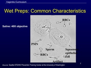 7
Wet Preps: Common Characteristics
RBCs
Squamous
epithelial
cell
PMN
RBCs
Sperm
Artifact
Saline: 40X objective
Vaginitis Curriculum
Source: Seattle STD/HIV Prevention Training Center at the University of Washington
 