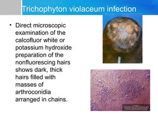 Trichophyton violaceum infection
• Direct microscopic
examination of the
calcofluor white or
potassium hydroxide
preparation of the
nonfluorescing hairs
shows dark, thick
hairs ﬁlled with
masses of
arthroconidia
arranged in chains.

 