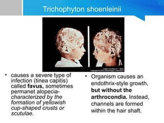 Trichophyton shoenleinii

• causes a severe type of
infection (tinea capitis)
called favus, sometimes
permanet alopeciacharacterized by the
formation of yellowish
cup-shaped crusts or
scutulae.

• Organism causes an
endothrix-style growth,
but without the
arthrocondia. Instead,
channels are formed
within the hair shaft.

 