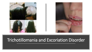 Trichotillomania and Excoriation Disorder
 
