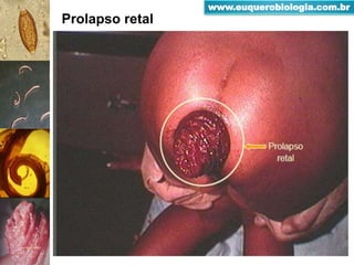 Prolapso retal
www.euquerobiologia.com.br
 